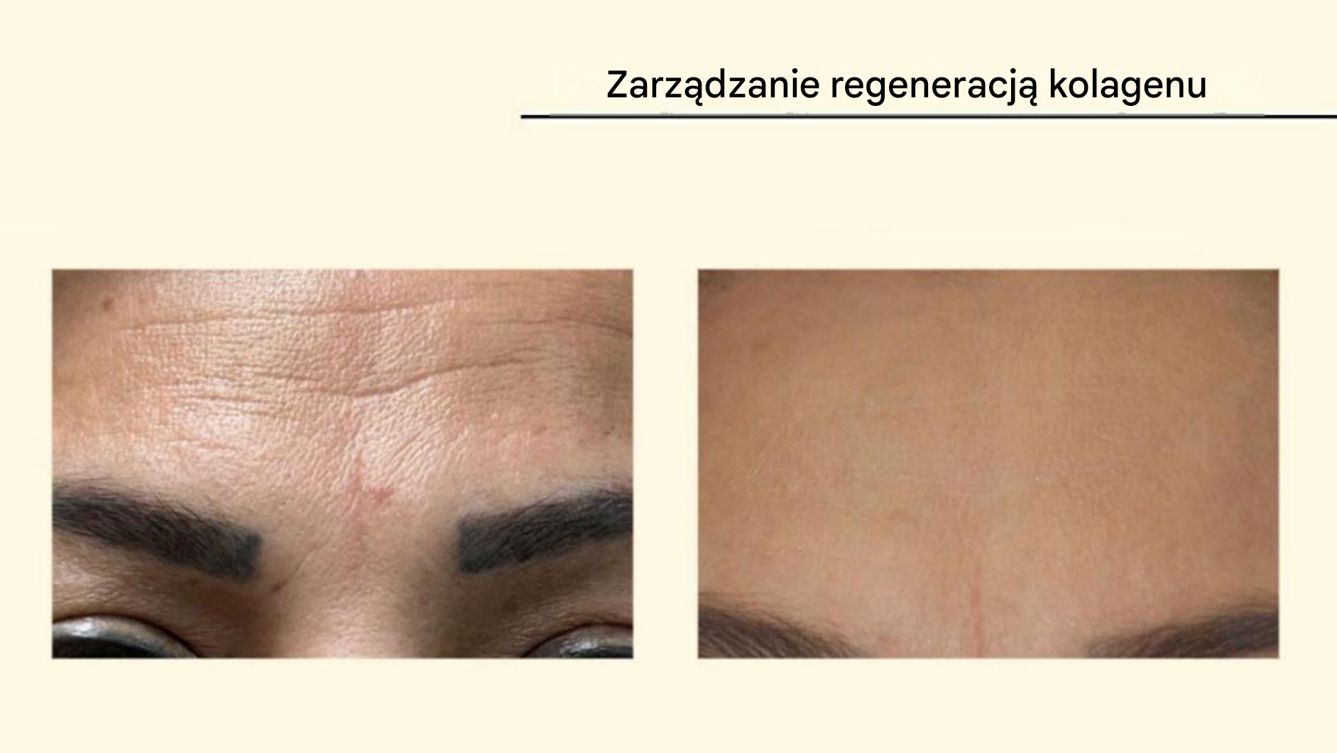 Plazma — regeneracja kolagenu